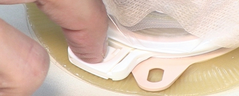 Dispositivo de mejora en ostomía